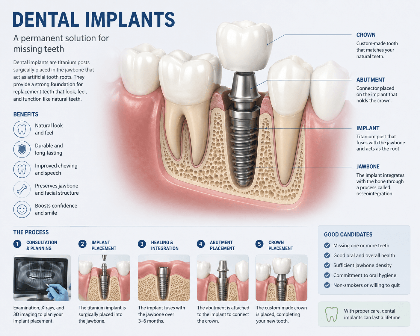 Dental Implants
